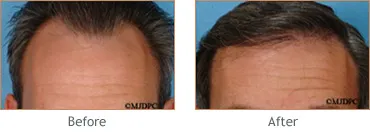 Alabama Hair Transplant at Hedden & Gunn Plastic Surgery gallery photo