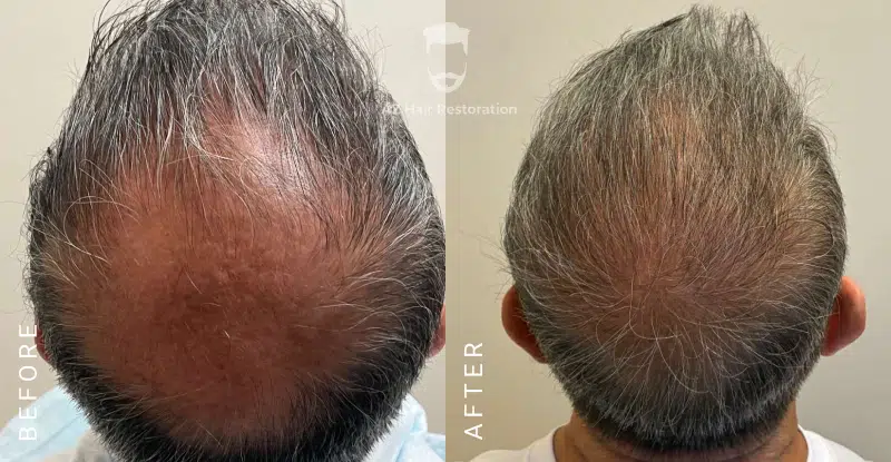 AZ Hair Restoration Clinic Raleigh gallery photo