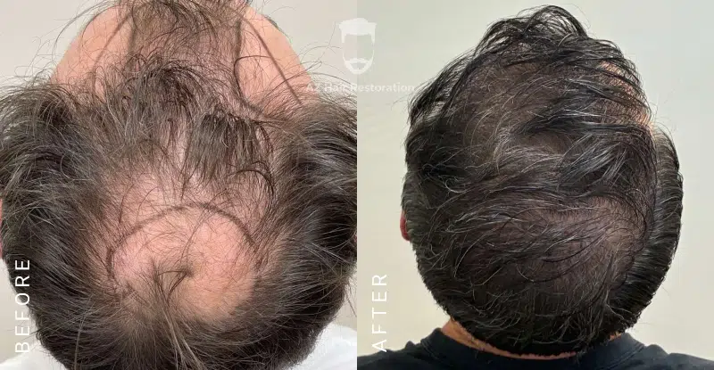 AZ Hair Restoration Clinic Raleigh gallery photo