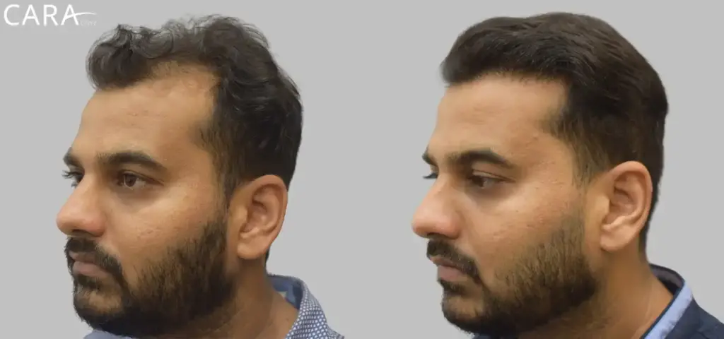 CARA Hair Transplant & Aesthetic Clinic Mumbai gallery photo
