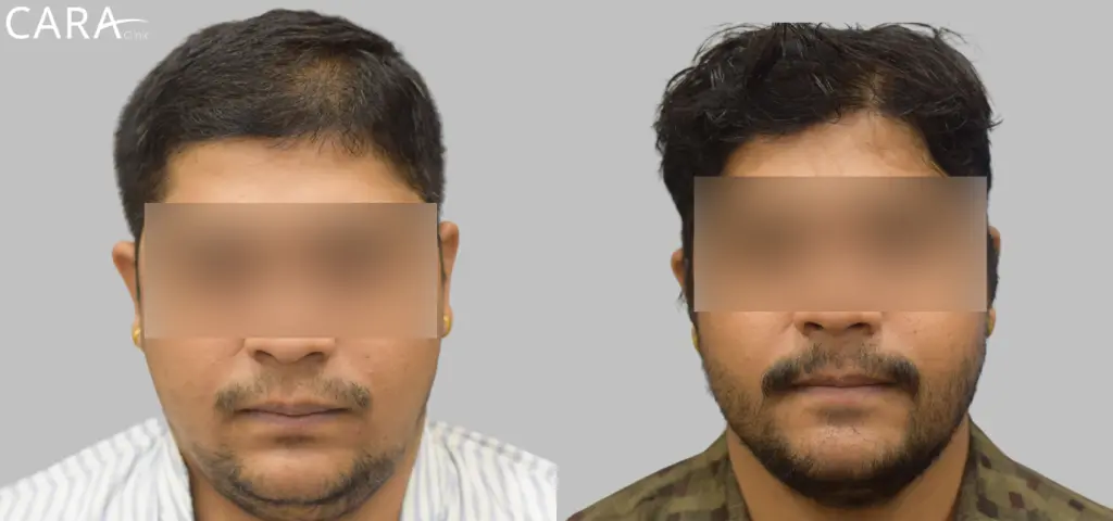 CARA Hair Transplant & Aesthetic Clinic Mumbai gallery photo