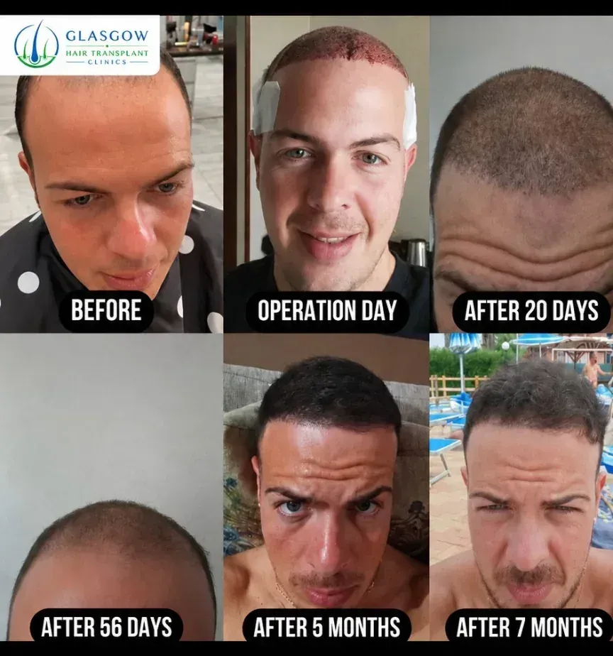 Glasgow hair transplant clinics gallery photo