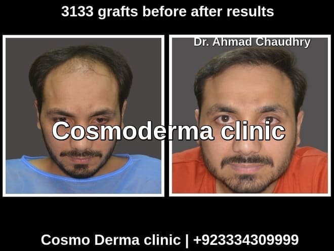 Hair transplant clinic Lahore Dr. Ahmad CH gallery photo