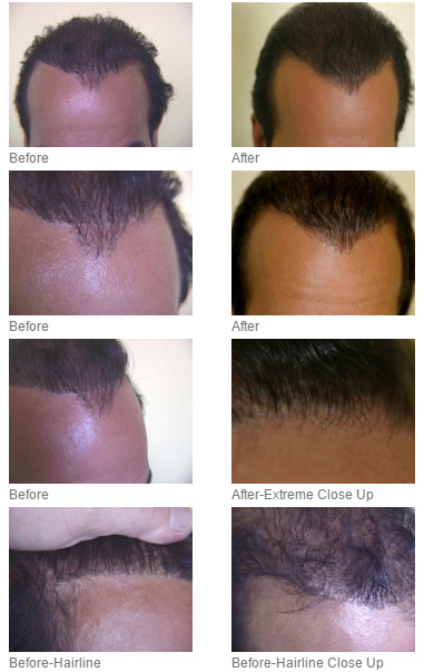 The Woods Technique – Dr Ray Woods FUE Hair Transplant gallery photo