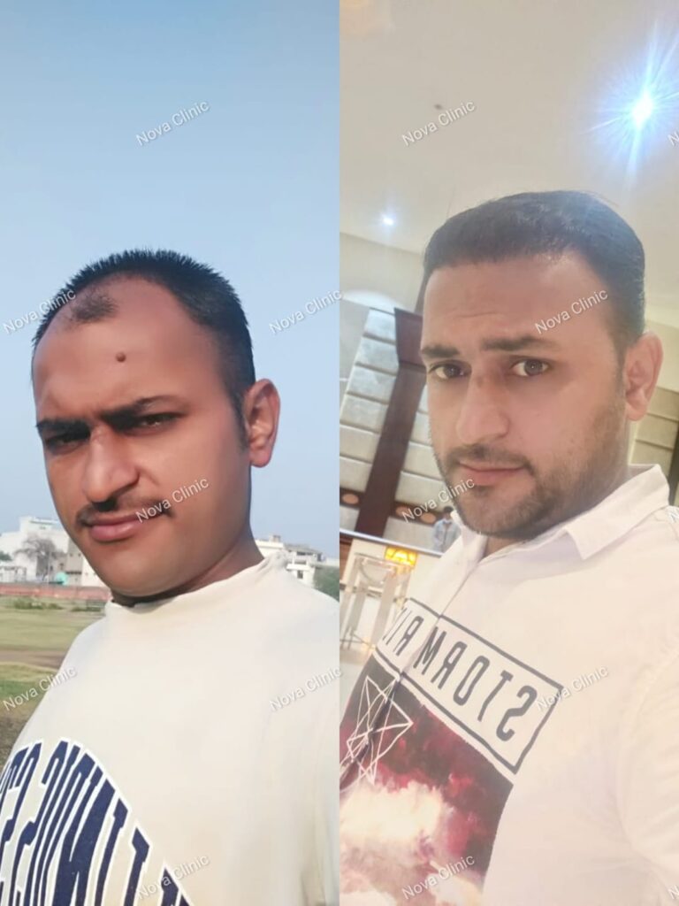 Nova Hair and Skin Clinic — Mohali gallery photo