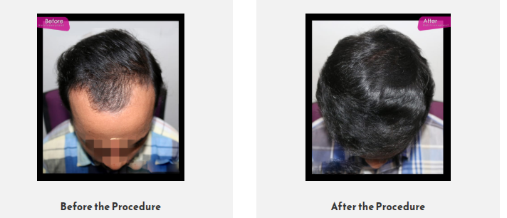 Rejoice Hair Transplant gallery photo