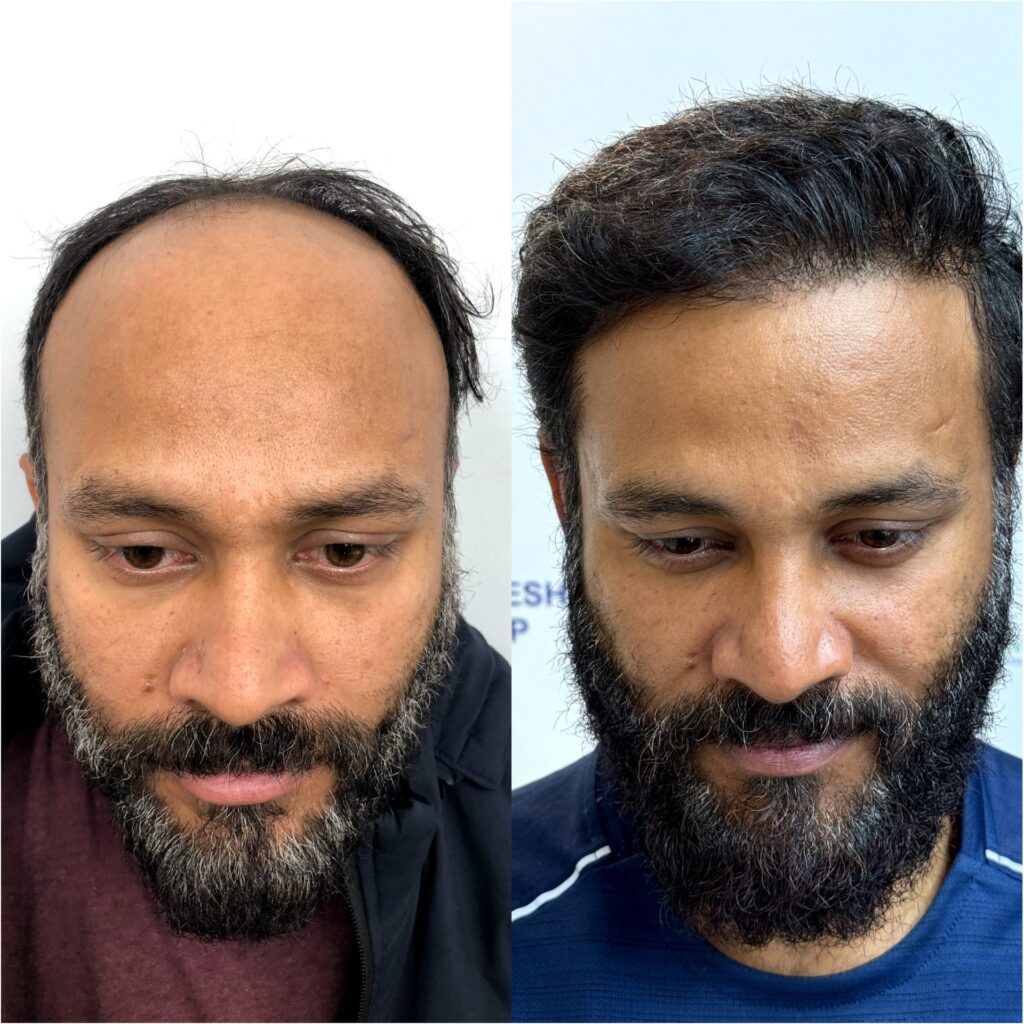 Dermaiims Hair Transplant Clinic Delhi gallery photo