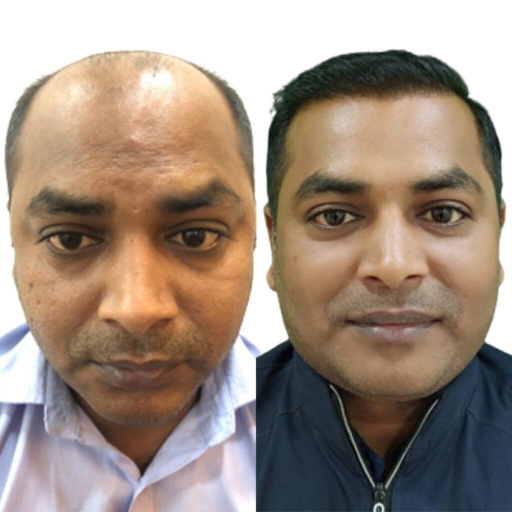 Dermaiims Hair Transplant Clinic Delhi gallery photo