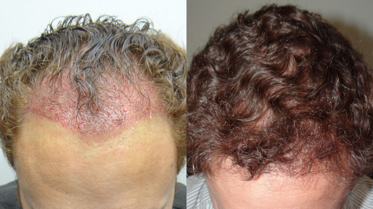 SAVANT Hair Transplant Mexico gallery photo