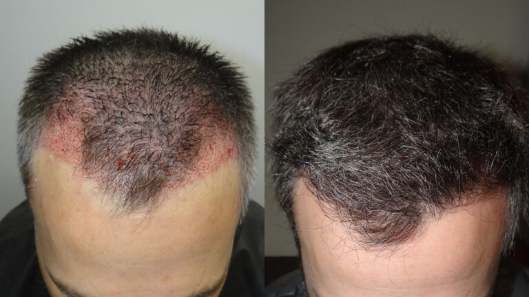 SAVANT Hair Transplant Mexico gallery photo
