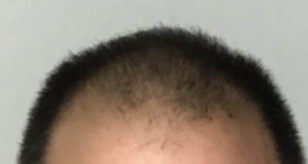 Hair Restoration & Aesthetics of Buffalo gallery photo