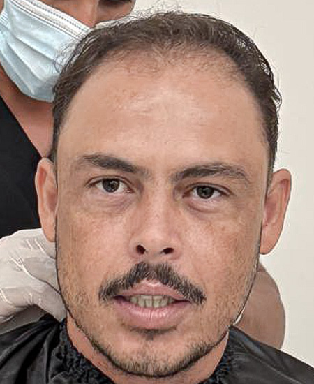 Dr. Rafael Lobo Transplante Capilar Vitória gallery photo