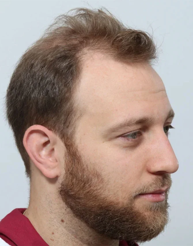 Dr. Benjamin Paul Hair Transplant New York gallery photo