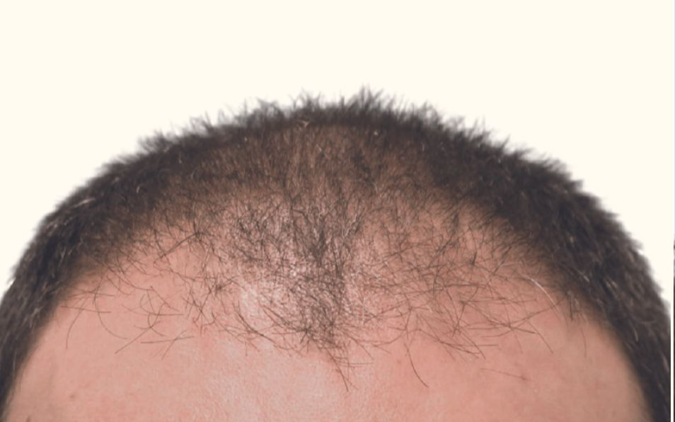 Aesthetic Hair Restoration Houston gallery photo