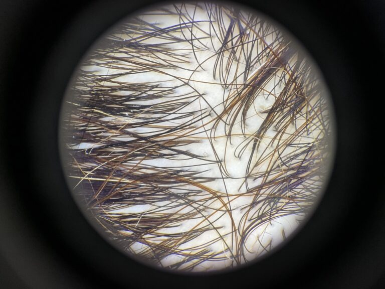 Medellin Hair Transplant gallery photo