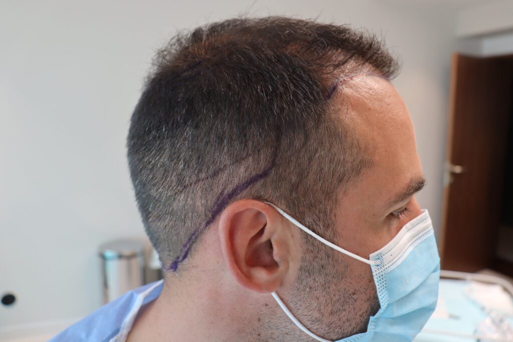 Hairvolution – Transplante Capilar gallery photo