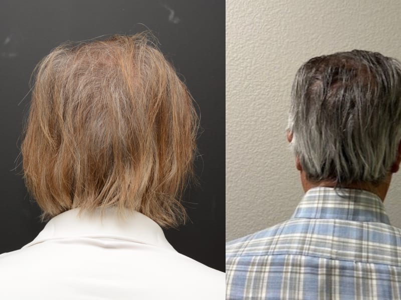 Hair Transplant Newport Beach gallery photo