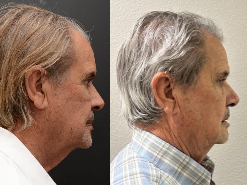 Hair Transplant Newport Beach gallery photo