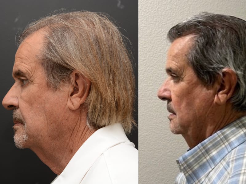 Hair Transplant Newport Beach gallery photo