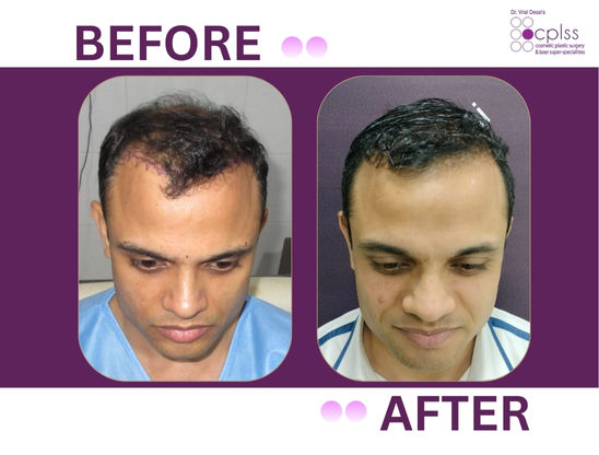 CPLSS – Dr. Viral Desai Hair Transplant Mumbai gallery photo