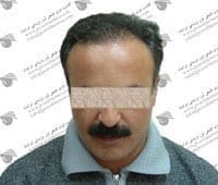 Iranian Hair Transplantation and Laser Clinic Isfahan gallery photo