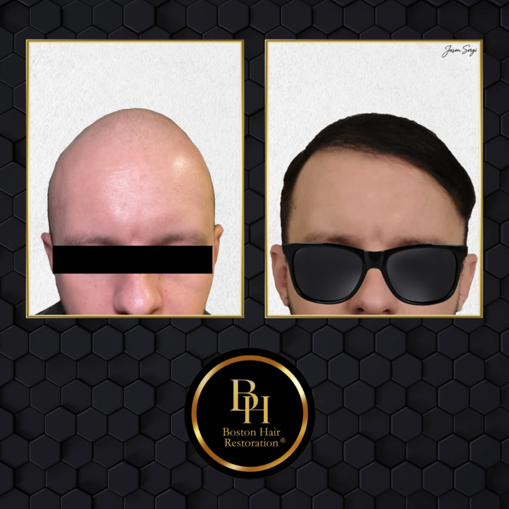 Boston Hair Restoration ® gallery photo