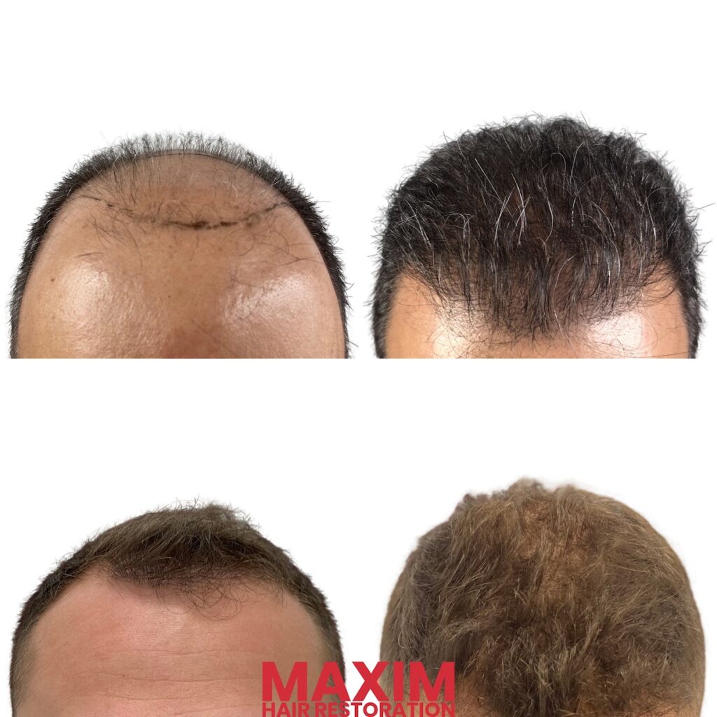 Maxim Hair Restoration & Transplants – Charlotte gallery photo