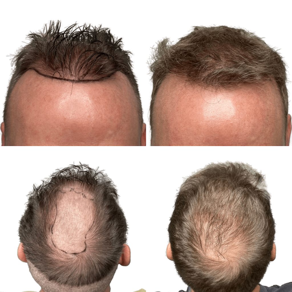 Maxim Hair Restoration & Transplants – Charlotte gallery photo