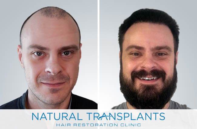 Natural Transplants, Hair Restoration Clinic gallery photo
