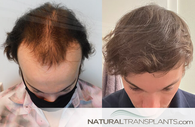 Natural Transplants, Hair Restoration Clinic gallery photo