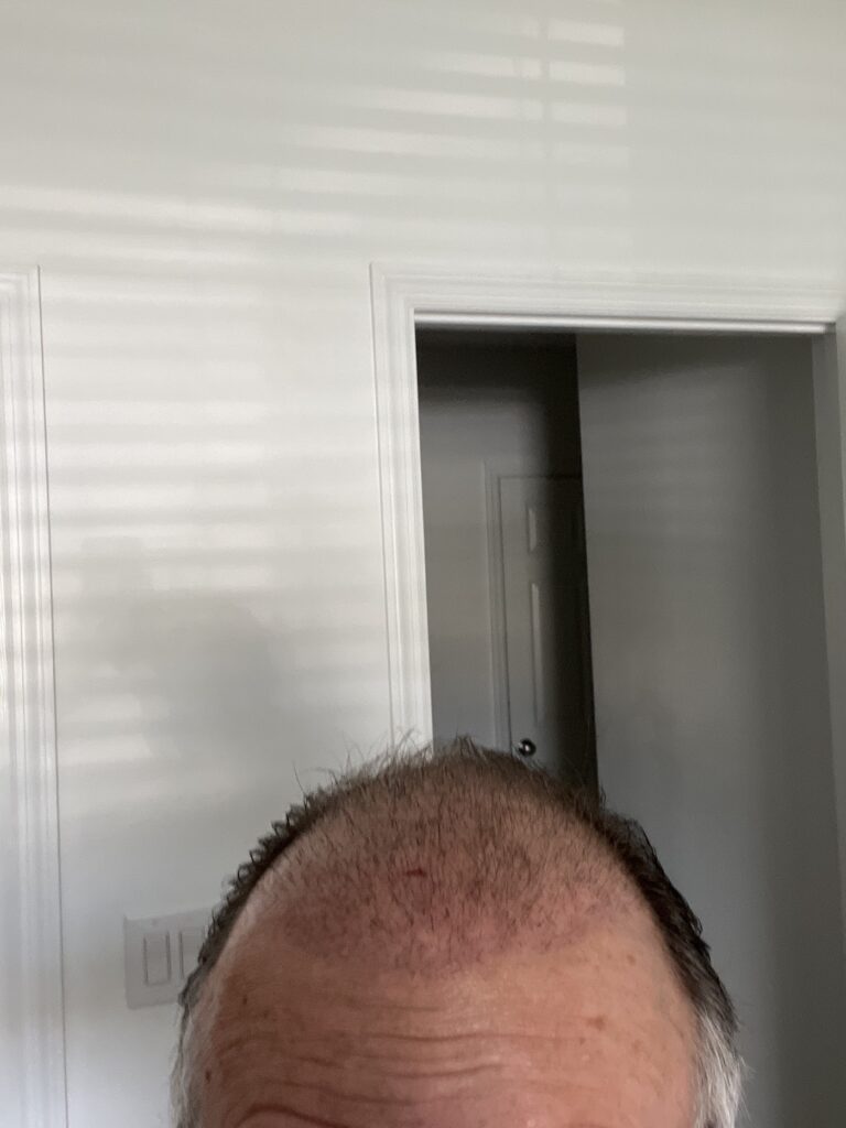Hair Transplants of Florida gallery photo
