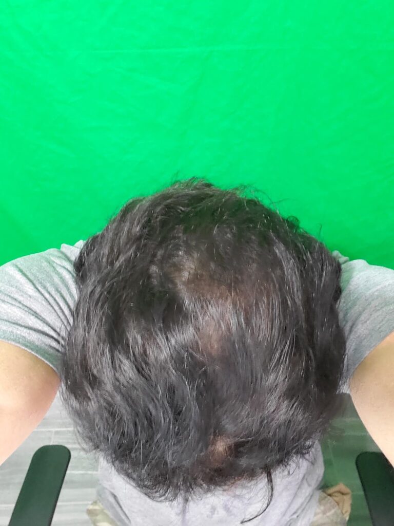 Hair Transplants of Florida gallery photo