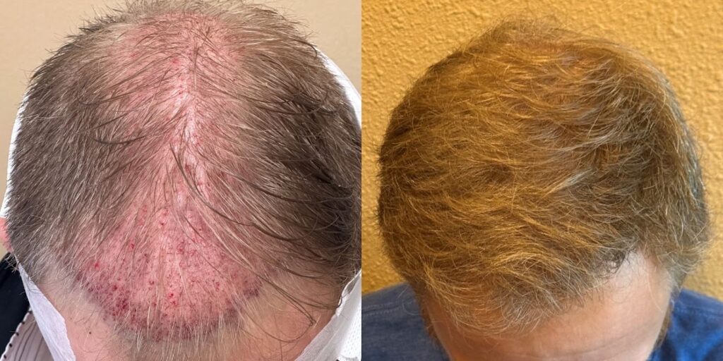 American Hair Transplants | DC & Virginia Hair Restoration Clinic gallery photo