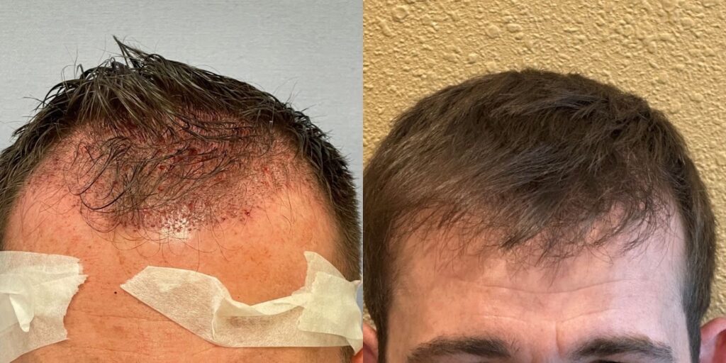 American Hair Transplants | DC & Virginia Hair Restoration Clinic gallery photo