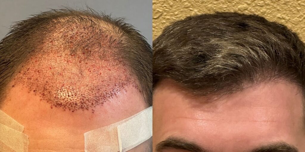 American Hair Transplants | DC & Virginia Hair Restoration Clinic gallery photo