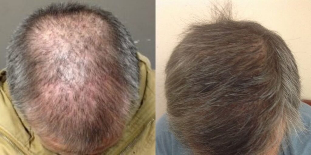 American Hair Transplants | DC & Virginia Hair Restoration Clinic gallery photo