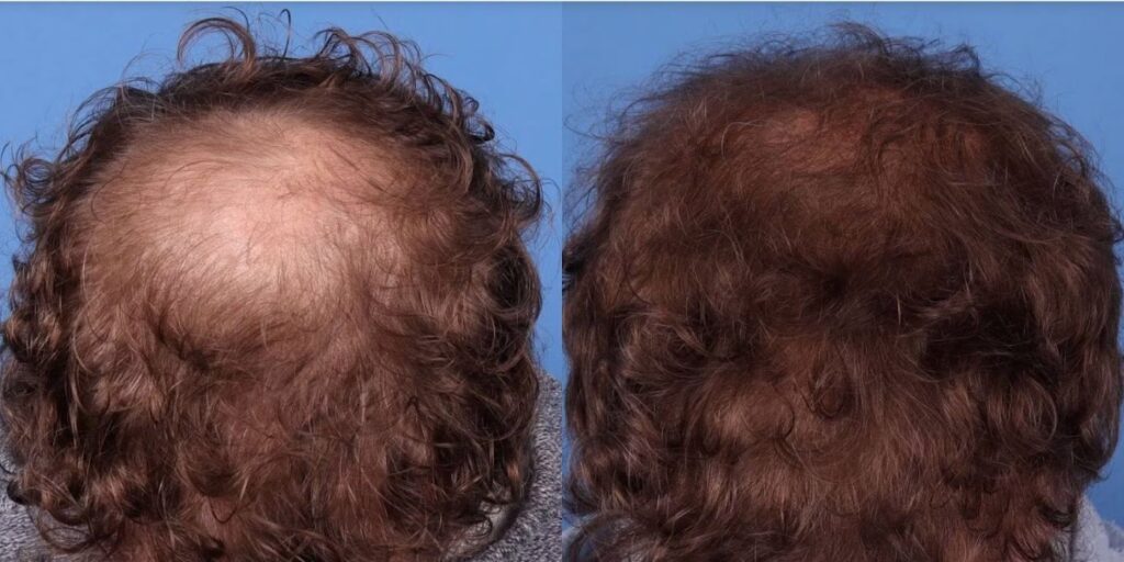 American Hair Transplants | DC & Virginia Hair Restoration Clinic gallery photo