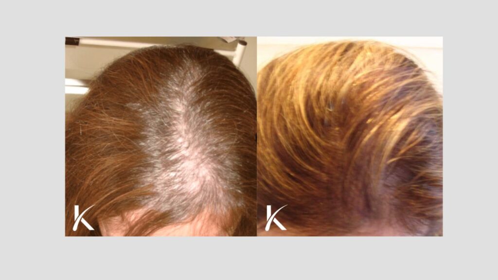 Kopelman Hair Restoration Florida | Hair Transplant Clinic gallery photo