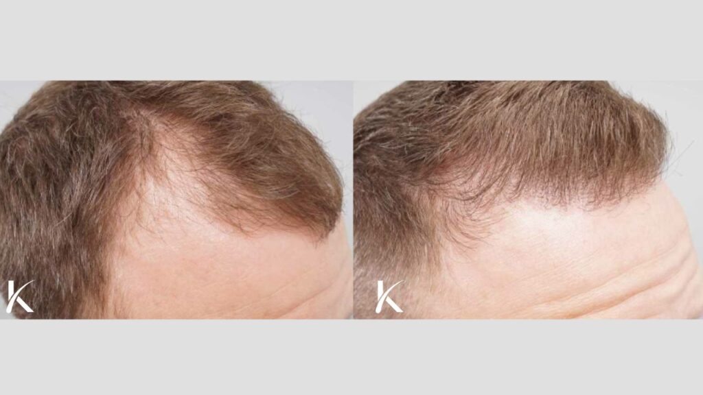 Kopelman Hair Restoration Florida | Hair Transplant Clinic gallery photo