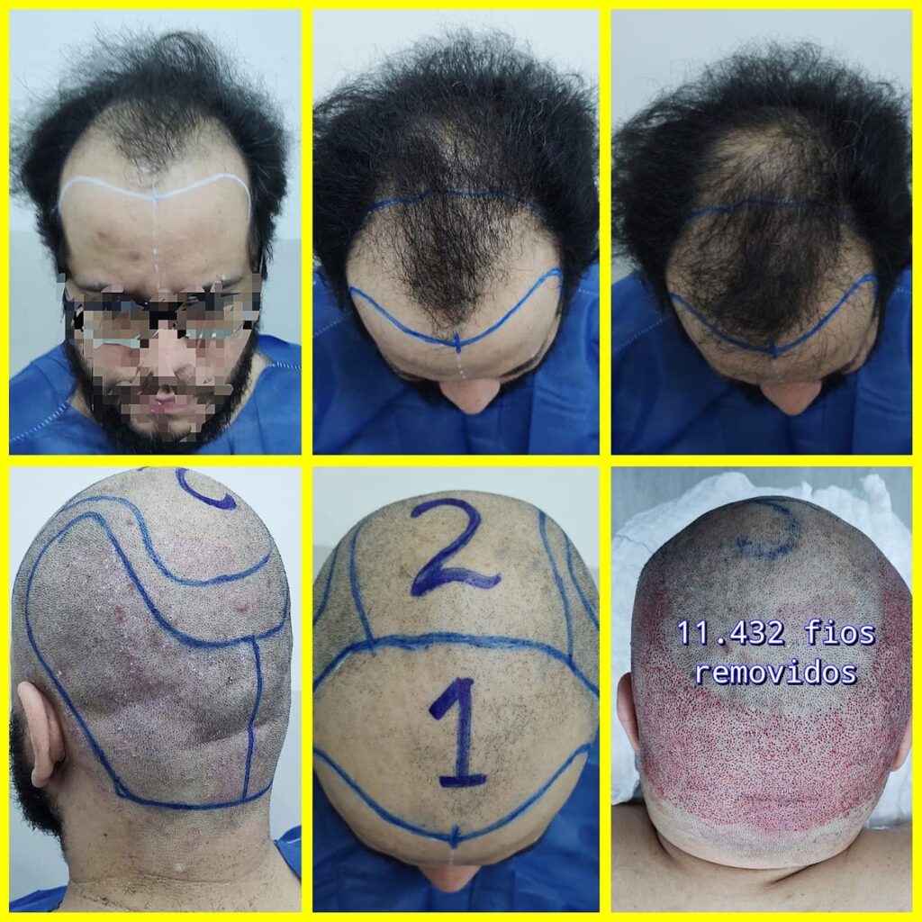 Hair Transplante Transplante capilar na zona sul de São Paulo gallery photo