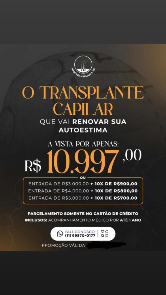 Hair Transplante Transplante capilar na zona sul de São Paulo gallery photo