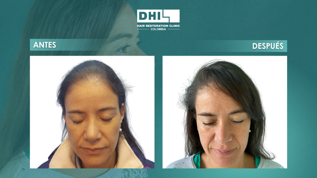 DHI COLOMBIA BARRANQUILLA ( Clínica de implante capilar) gallery photo