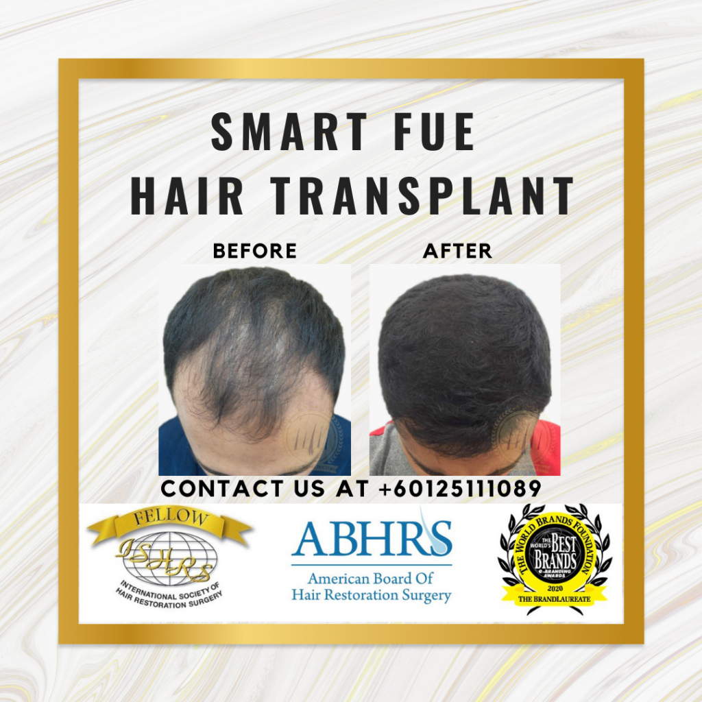 SMART FUE Hair Transplant & Hair Loss Awards Winning Clinic Year 2023 in Asia Pacific |Pakar Rambut|Malaysia Book of Records gallery photo