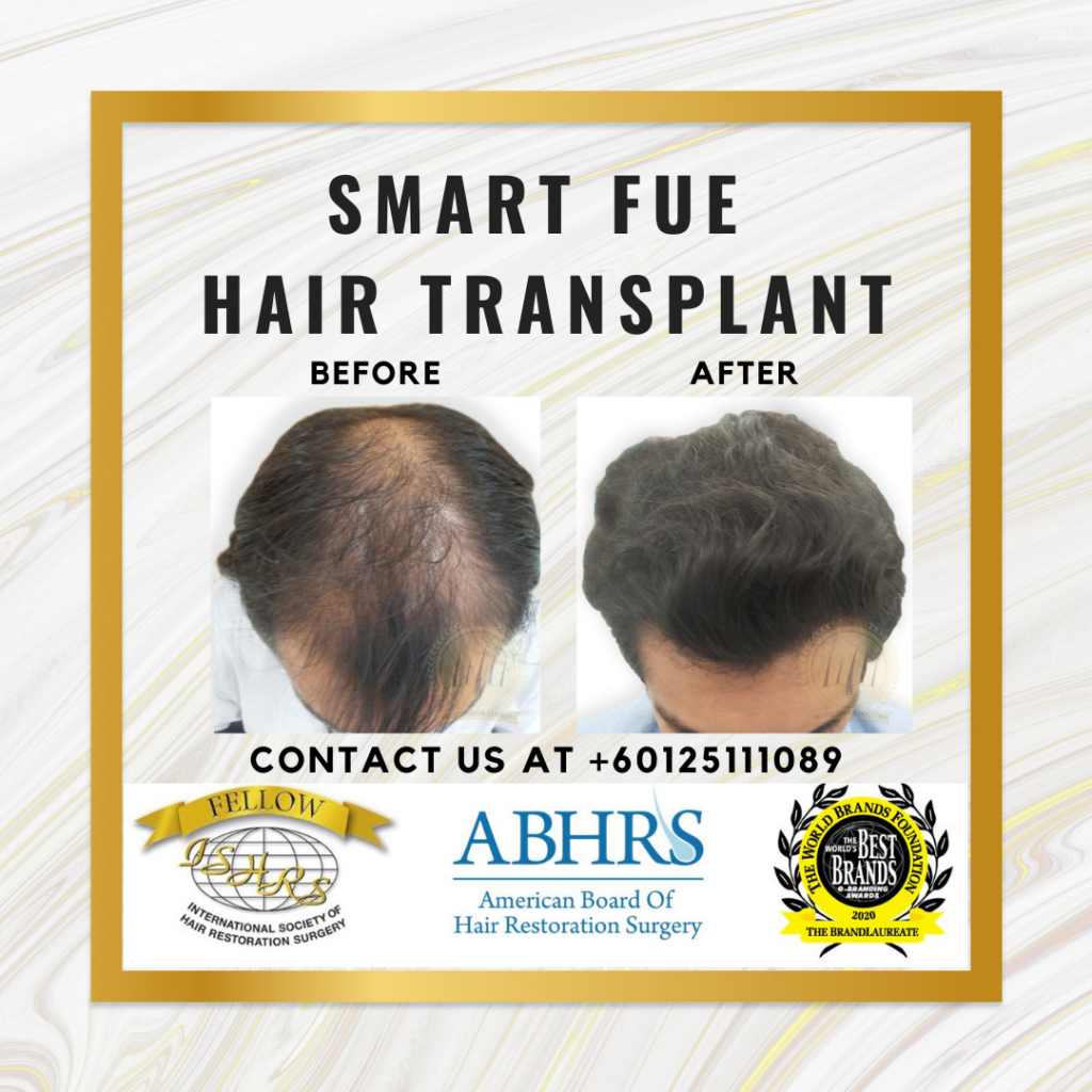 SMART FUE Hair Transplant & Hair Loss Awards Winning Clinic Year 2023 in Asia Pacific |Pakar Rambut|Malaysia Book of Records gallery photo