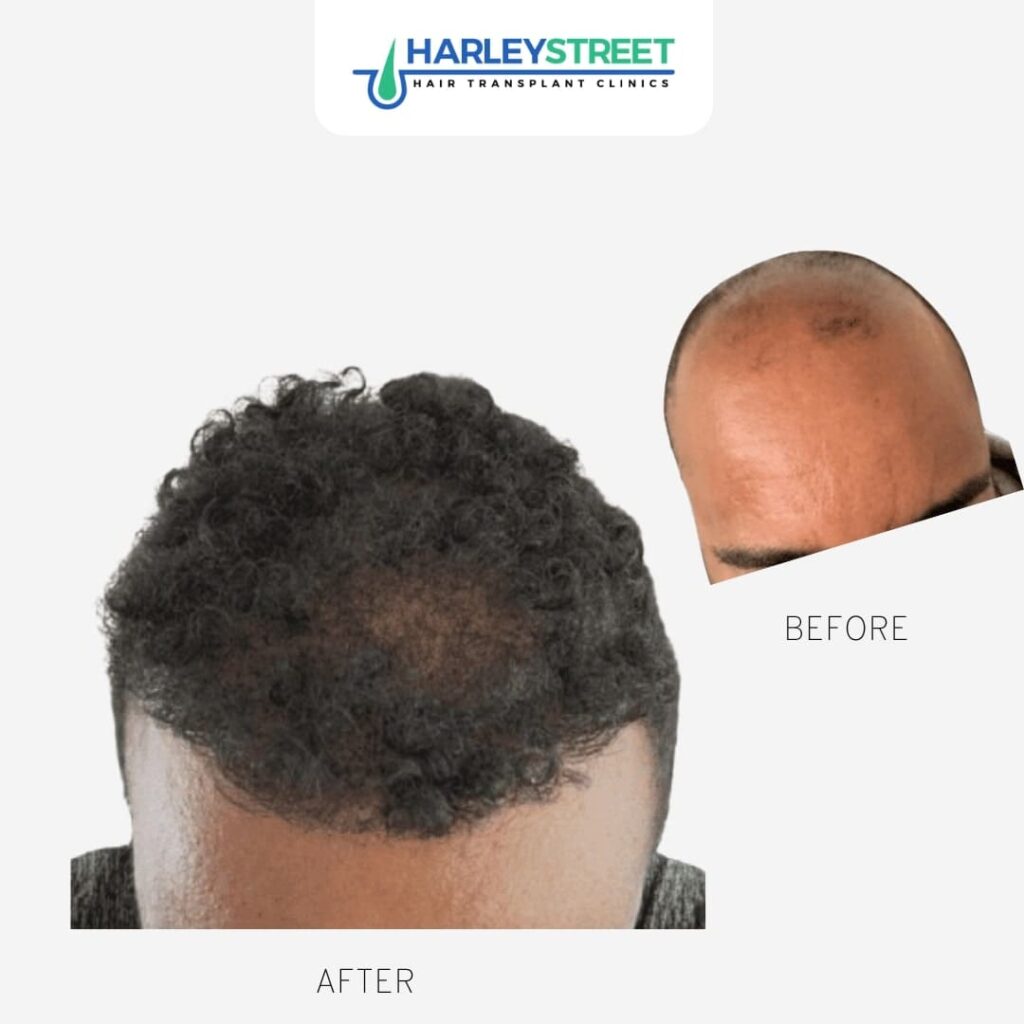 Hair Transplant Glasgow gallery photo