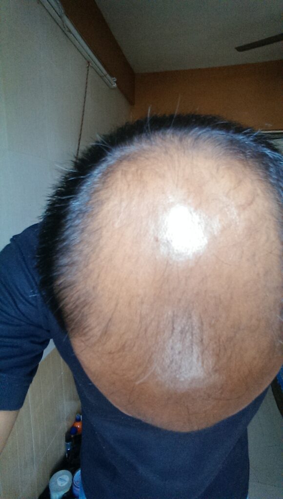 UK Hair Transplant Clinics Manchester gallery photo