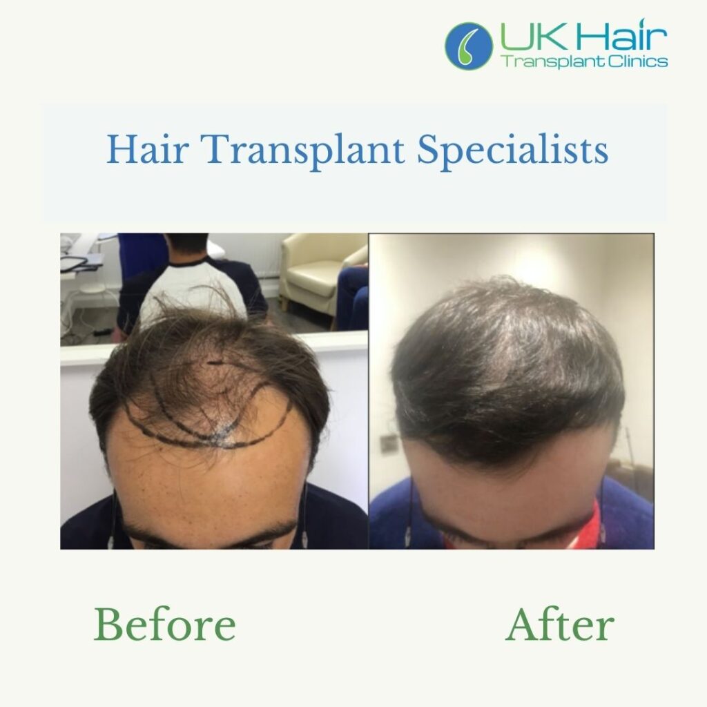 UK Hair Transplant Clinics Manchester gallery photo