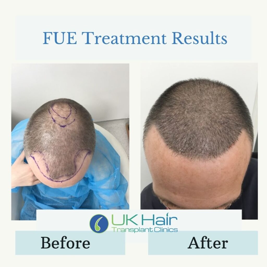 UK Hair Transplant Clinics Manchester gallery photo