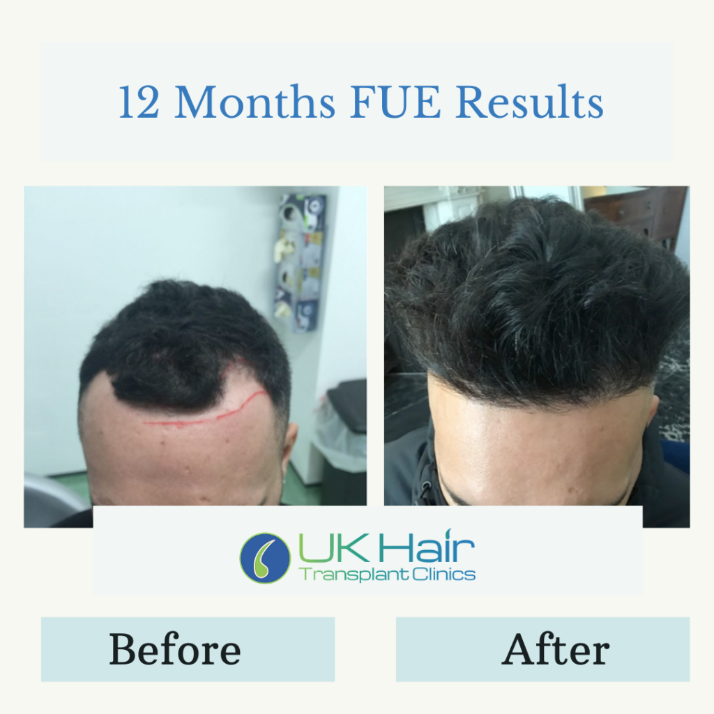 UK Hair Transplant Clinics Manchester gallery photo