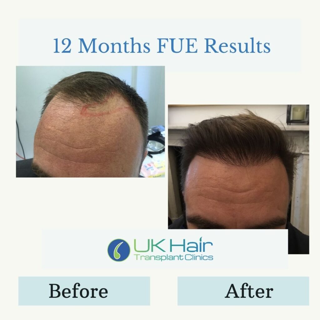 UK Hair Transplant Clinics Manchester gallery photo